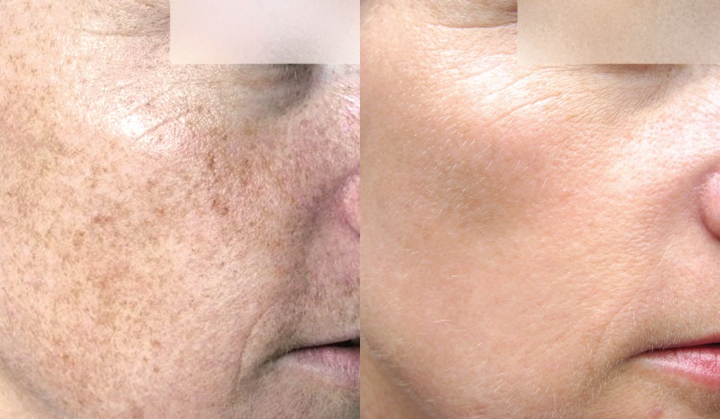 photorejuvenation example