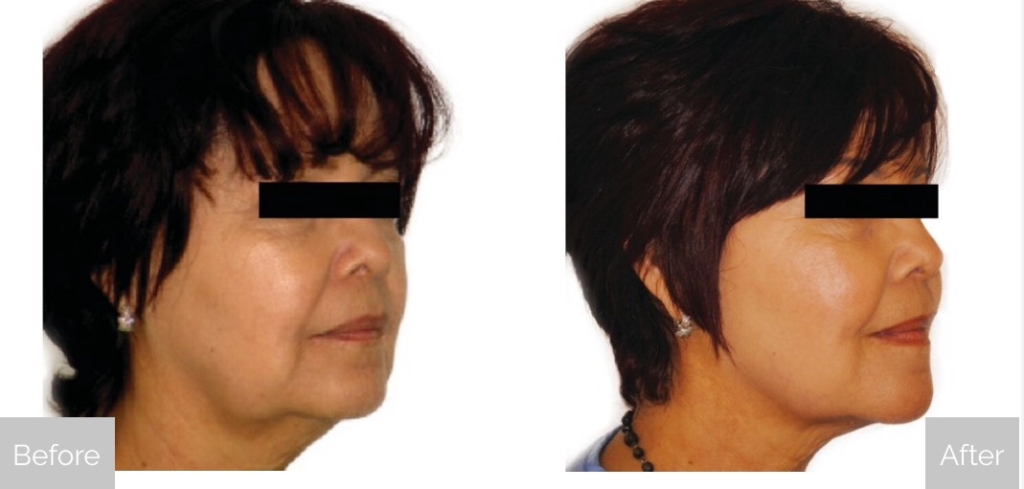 venus-swan-Before-and-After-Face-Neck-2